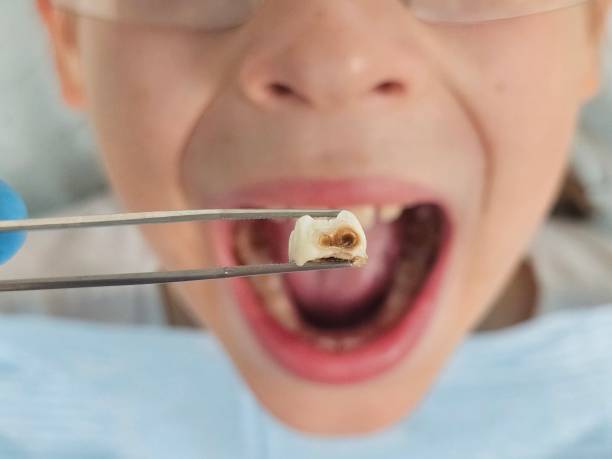 Best Emergency Wisdom Teeth Removal in Crenshaw, MS